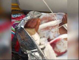 Campo Grande: Idosa é atacada por Pitbull e tem fratura exposta no Jardim Noroeste 
